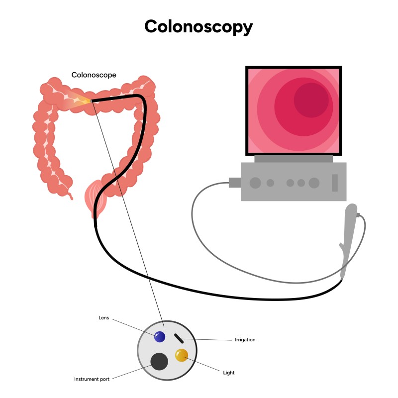 Colonoscopy