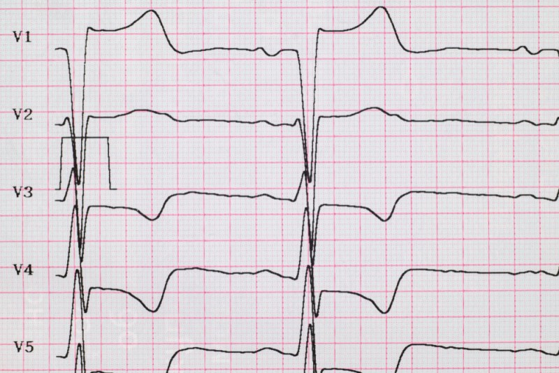 ECG