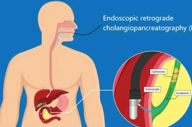 Endoscopic retrograde cholangiopancreatography (ERCP)