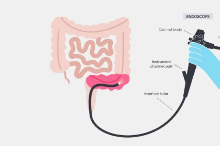 Sigmoidoscopy